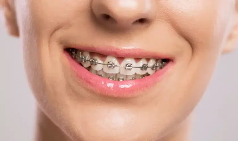 Harnessing the Power of Braces: A Journey into Enhanced Facial Recognition